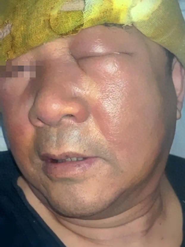 大爷经常挖鼻孔致满脸肿胀变形