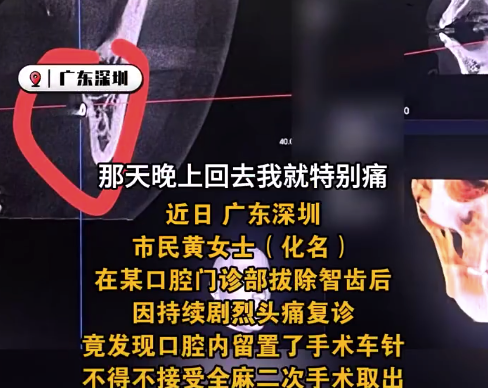 女子拔完智齿头痛难忍嘴里竟有根针：“一天喝了三次布洛芬”！